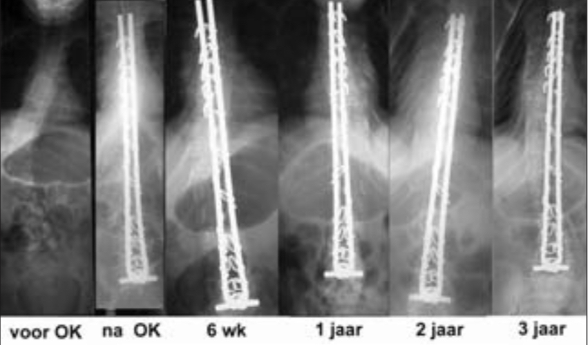 Rntgenfoto's van de rugwervel voor en na de operatie volgens 'de Methode Luque'